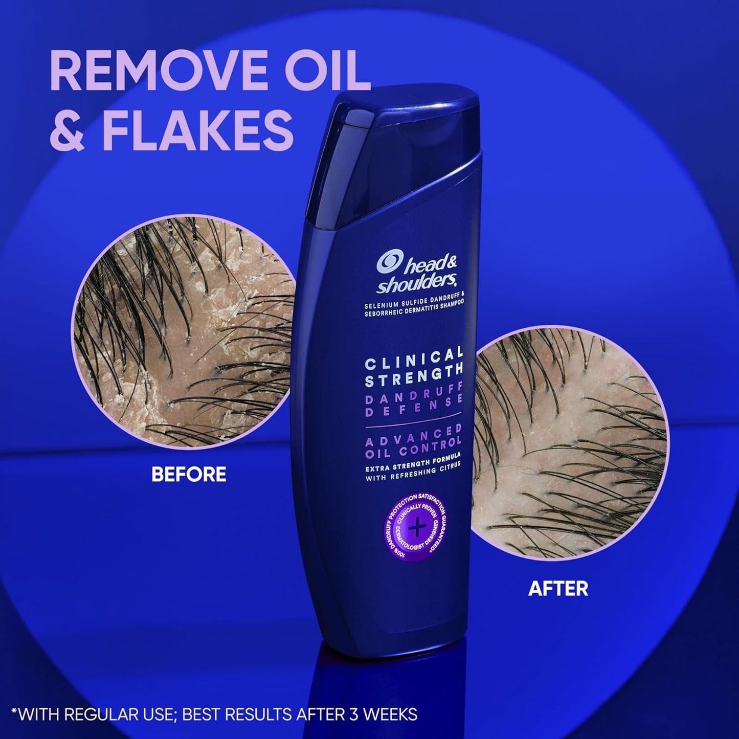 شامبو هيد اند شولدرز كلينيكال سترنث الامريكي  🇺🇲
Head & Shoulders Clinical Strength Dandruff Defense – Advanced Oil Control
شامبو علاجي بتركيبة متطورة يساعد على التخلص من القشرة والتحكم بالزيوت الزائدة مع تنظيف عميق لفروة الرأس